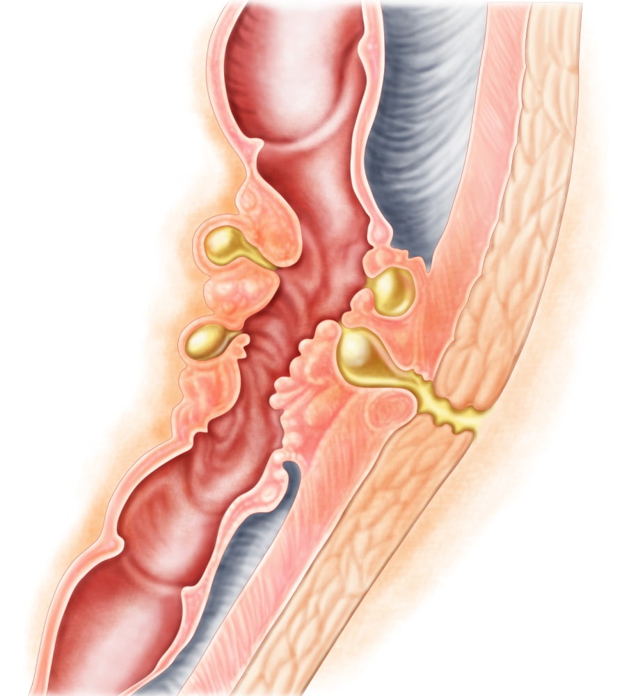 Development of fistula Canvas Art - Stocktrek Images (14 x 15)
