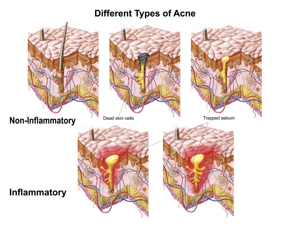 Different types of acne non-inflammatory and inflammatory Canvas Art - Stocktrek Images (16 x 13)
