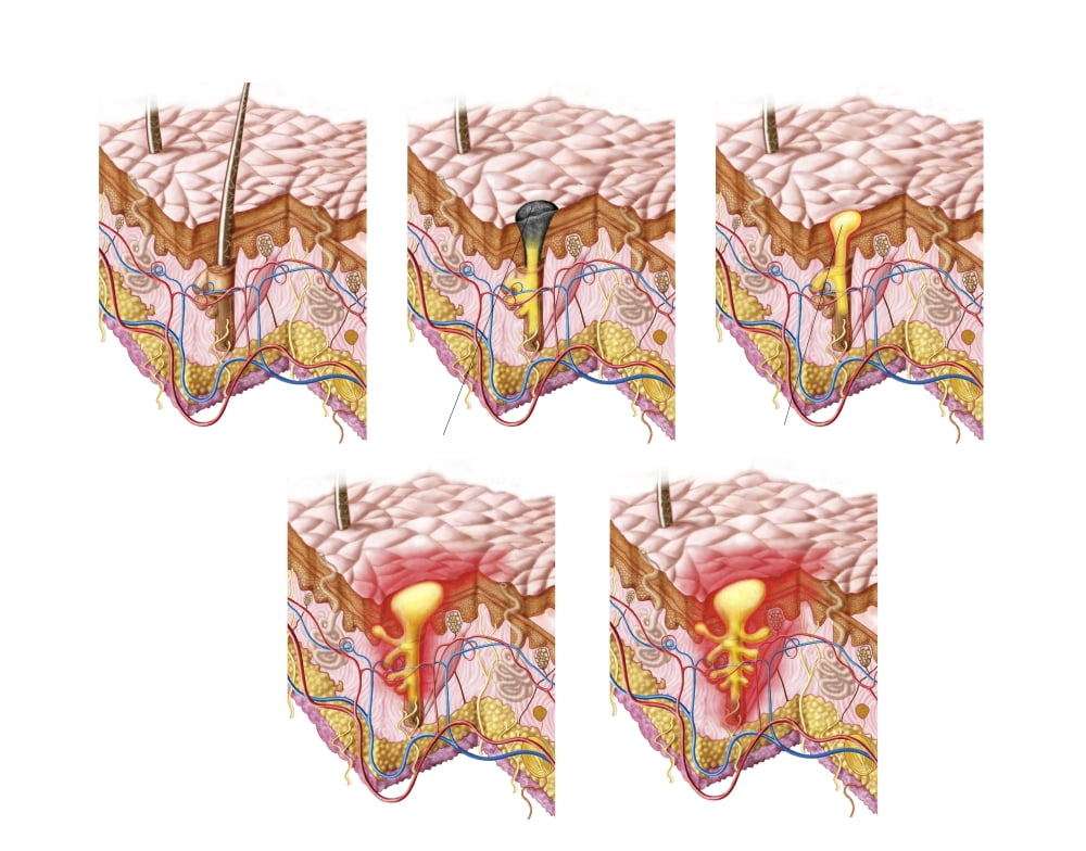 Different types of acne non-inflammatory and inflammatory Canvas Art - Stocktrek Images (32 x 25)