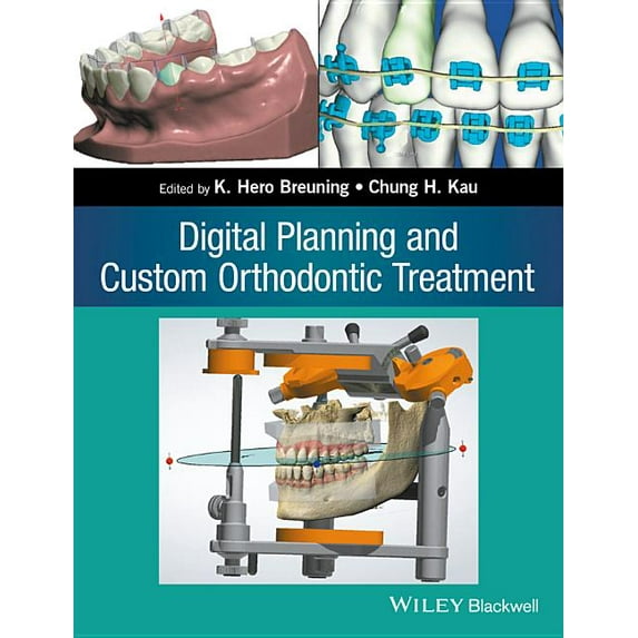 Digital Planning and Custom Orthodontic Treatment (Paperback)