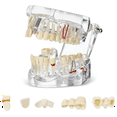 Disease Teeth Model Dental Typodonts Implant Teeth Model with Removable