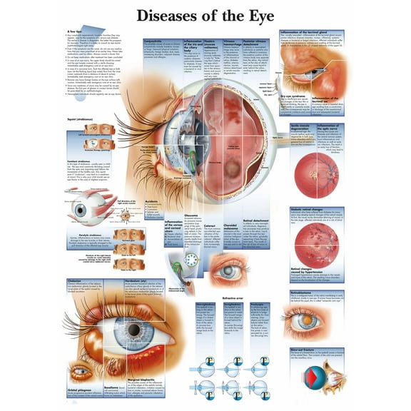 Diseases of The Eye Wall Art Posters Canvas Print Artwork Wall Chart Human Anatomy Wall Painting Office Hospital Room Home Decoration (without Framed),Multicolor