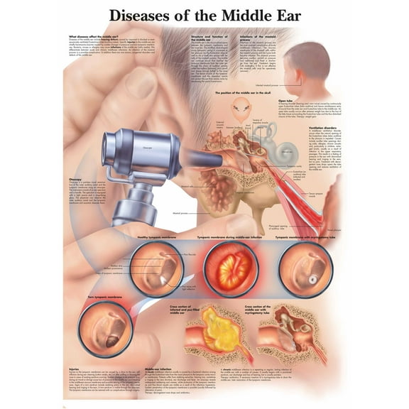 Diseases of the Middle Ear Wall Art Posters Canvas Print Artwork Wall Chart Human Anatomy Wall Painting Office Hospital Room Home Decoration (without Framed),Multicolor,16x19.7 inch(40x50 cm)