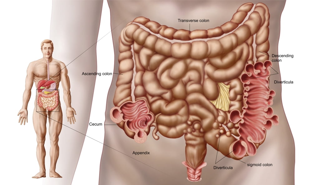 Diverticulitis in the descending colon region of the human intestine Canvas Art - Stocktrek Images (37 x 22)