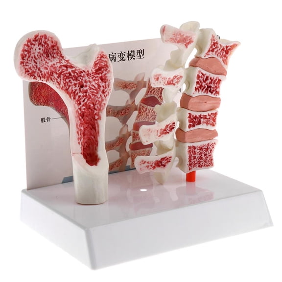 Dualoai 1:1 Human Osteoporosis Skeleton Pathologica Model for Anatomy, Lab Demonstration