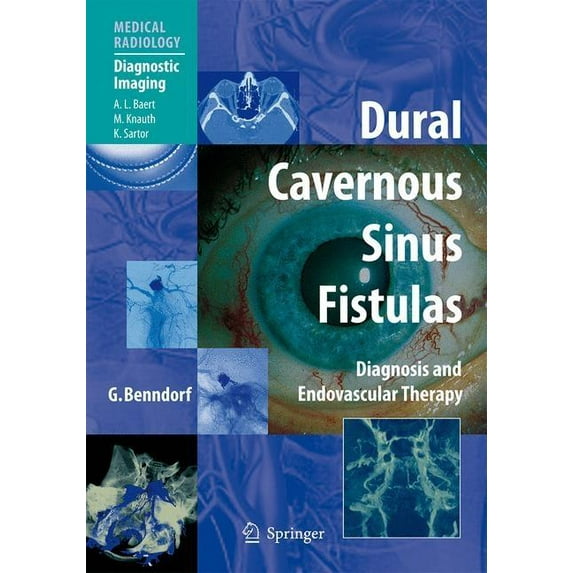 Dural Cavernous Sinus Fistulas: Diagnosis and Endovascular Therapy, (Hardcover)