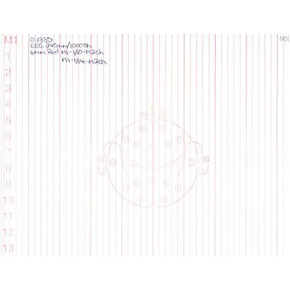 EEG Paper (245MM X 300MM X 1000 SHEETS) 10/14 Channel, Fv245-30k, Head on Every Page (Case of 2 Packs