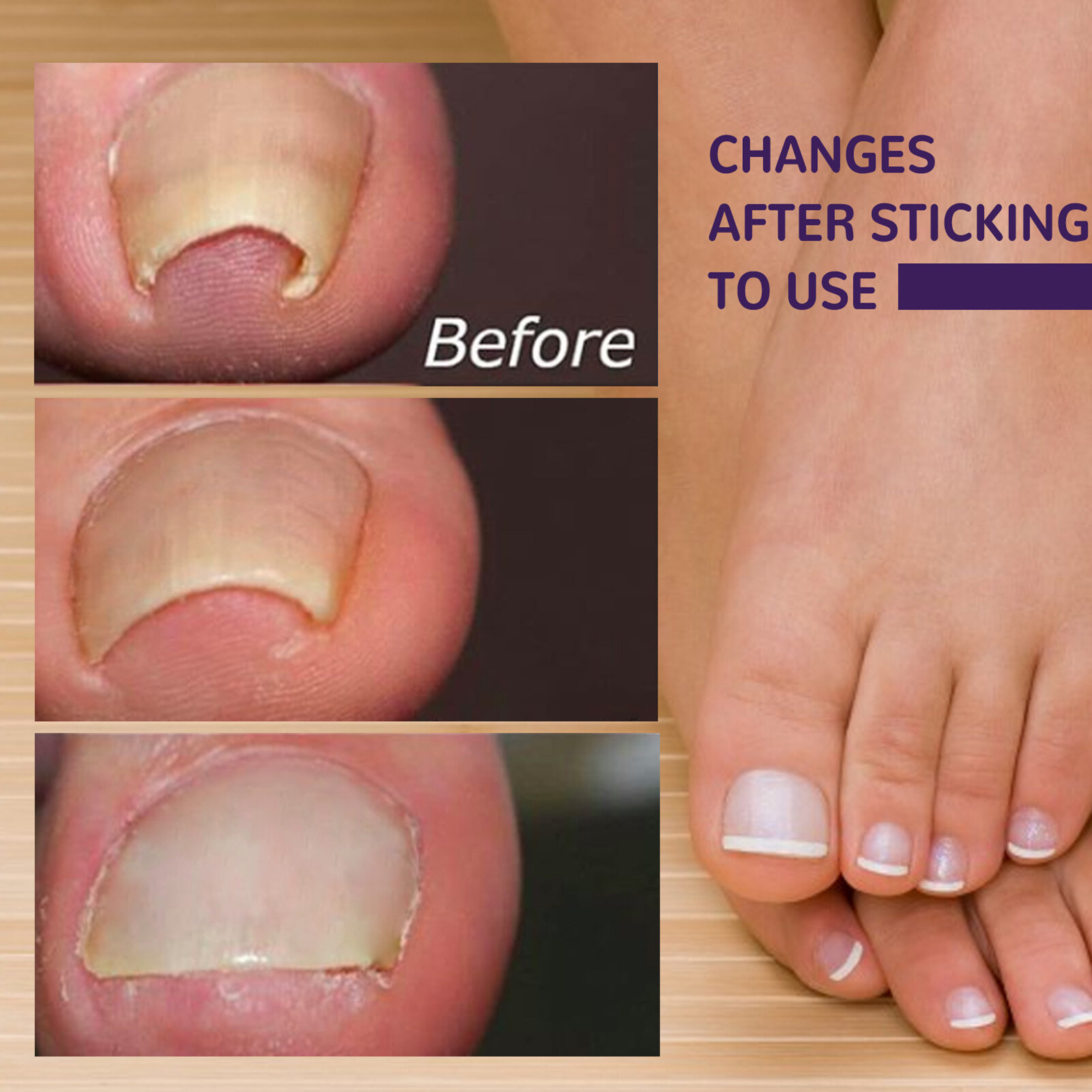 EELHOE Toenail Correction Sticker,Feet Pain Elastic Adhesive Dsfen