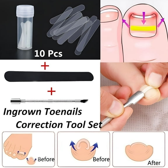 ELDORIX Ingrown Toenail- Straightening Clip Curved Toenails Thick Correction Tool Foot. Transparent Straightening Elastic Patch