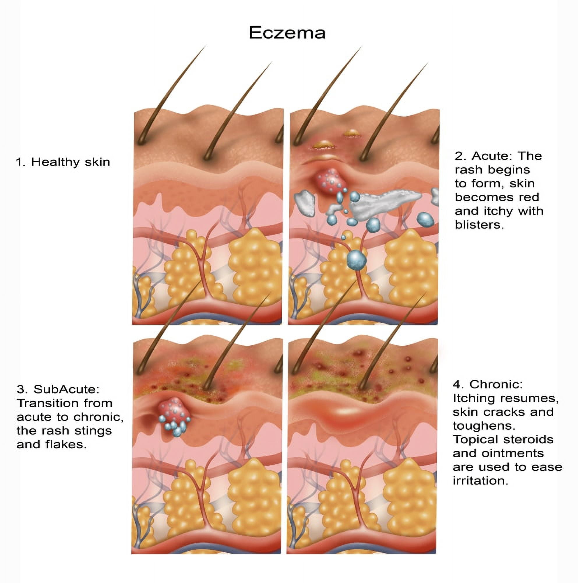 Eczema Poster Print by Gwen Shockey/Science Source (18 x 18) - Walmart.com