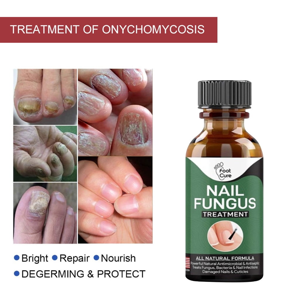 FUNGUSS Fungal Nail Fungus Treatment Damaged Discoloration Nail Cuticles  Relief | eBay