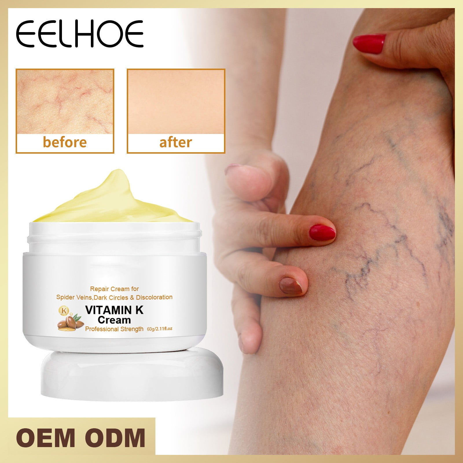 Esmndop Vitamin K Varicose Veins Miracle Cream Leg Swelling Earthworm