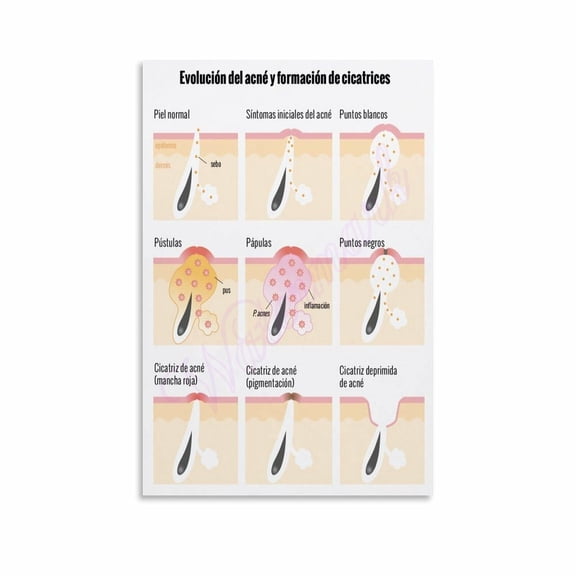Evolution of Acne And Scar Formation Skin Anatomy Beauty Posters Canvas Painting Posters And Prints Wall Art for Living Room Bedroom Decor