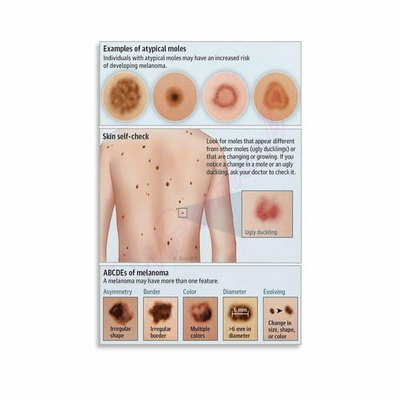 Examples of Atypical Moles Dermatology Posters Canvas Painting Wall Art Poster for Bedroom Living Room Decor poster