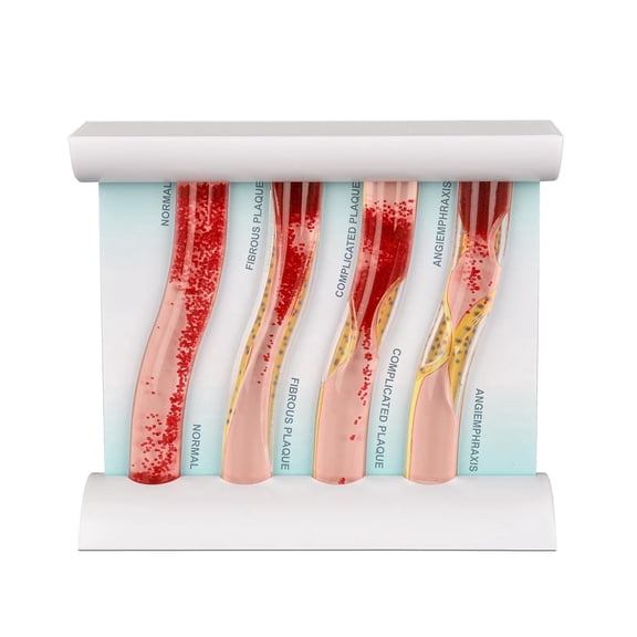Eztrain Low-Density Lipoprotein LDL Blood Vessel Model for Medical Patient Doctor Teaching, Vascular Demonstration Training Tool, Four Stage Vascular Conditions