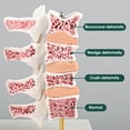 thumbnail image 1 of Eztrain Osteoporosis Model, Human Vertebrae Anatomical Model for Teaching Demonstration, 1 of 2