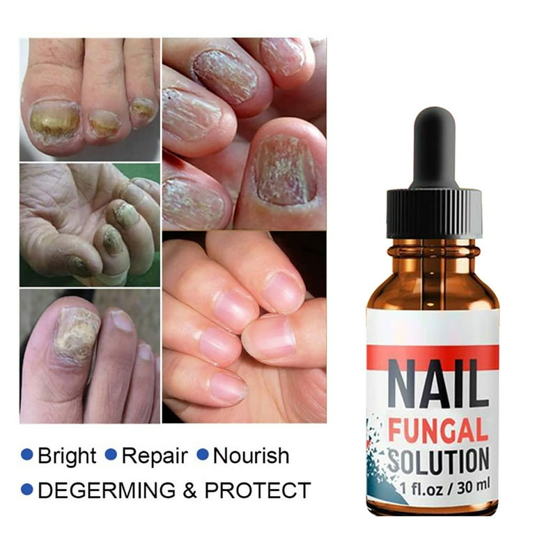 Fungal nail infection on sale treatment