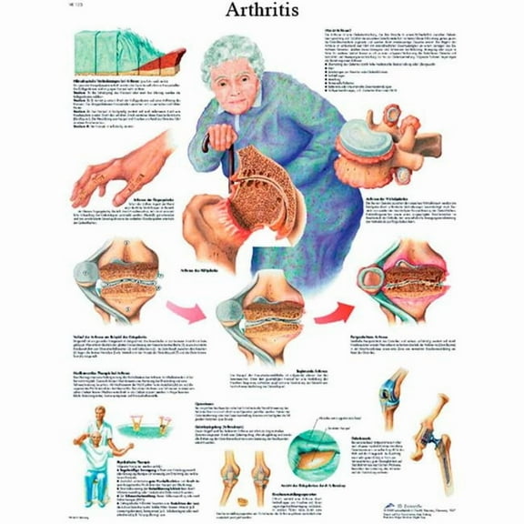 Fabrication B2138129 3B Anatomical Chart - Arthritis, Paper