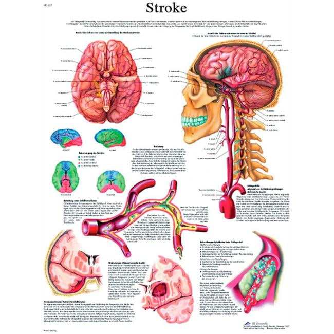 Fabrication B2138091 3B Anatomical Chart - Stroke Chart, Laminated