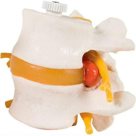 Fabrication B2138085 3B Anatomical Model - 2 Lumbar Vertebrae with Prolapsed Disc, Flexibly Mounted