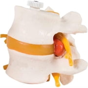 Fabrication B2138085 3B Anatomical Model - 2 Lumbar Vertebrae with Prolapsed Disc, Flexibly Mounted
