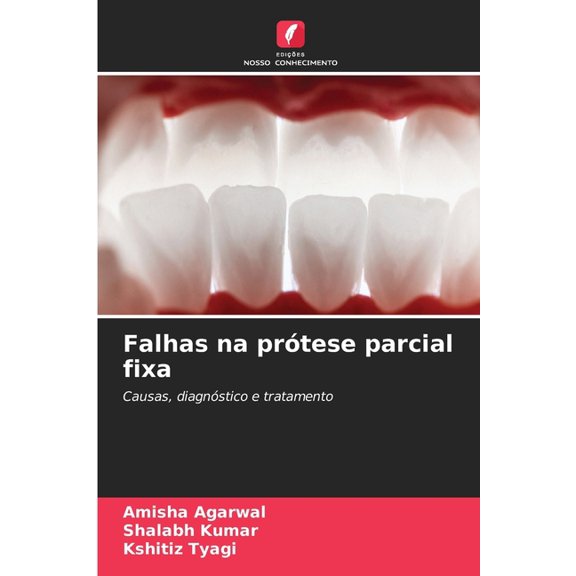 Falhas na prótese parcial fixa, (Paperback)
