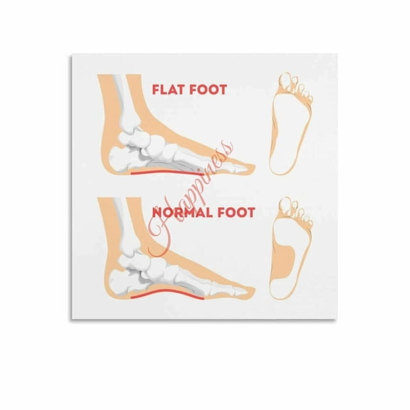 Flat Foot Vs Normal Foot Comparison Guide Poster Clinics Education Wall Art Canvas Painting Wall Art