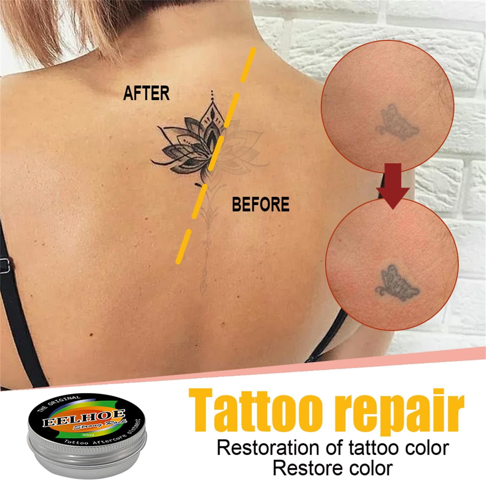 Your Ultimate Guide To Fotona Tattoo Removal Treatment- Dr Tanja Phillips  Clinic