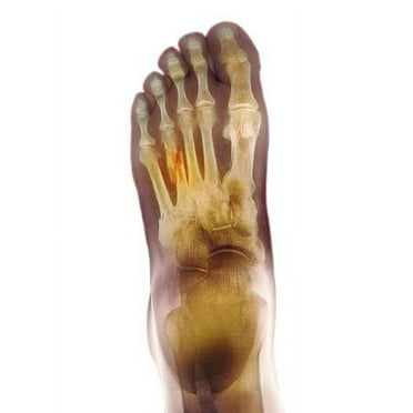 Fractured Foot, Xray, Figurative Unframed Photographic Print Wall Art by Du Cane Medical Sold by ArtCom