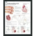 thumbnail image 1 of Framed Medical Poster Understanding ACS 22"x28" Wall Diagram Educational Informational Doctors Office Chart, 1 of 2
