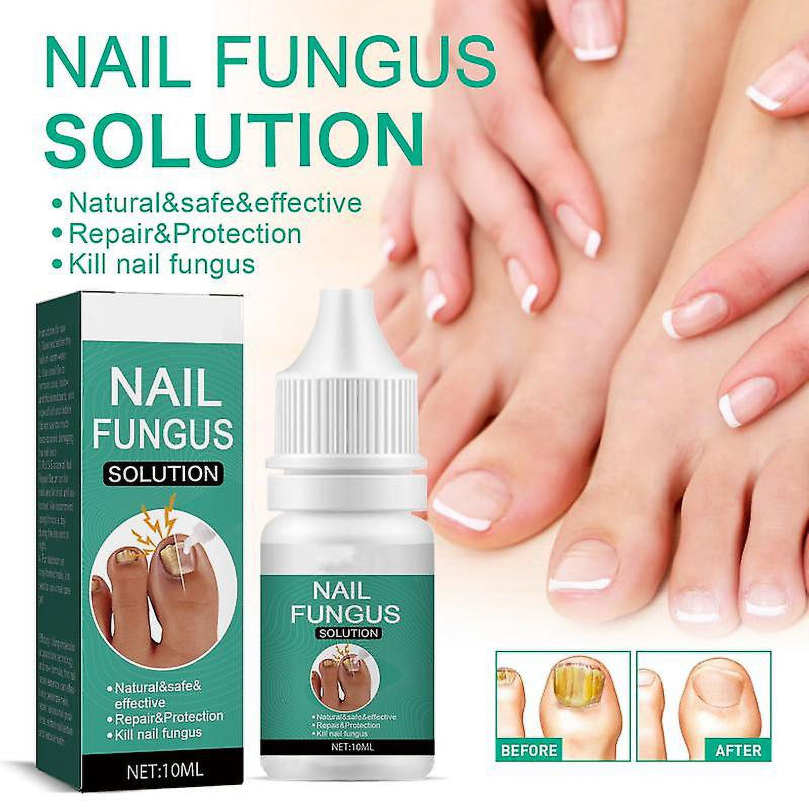 Fungal Nail Treatment For Toenail Extra Strong, Ingrown Toenail