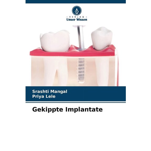 Gekippte Implantate, (Paperback)