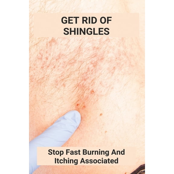 Get Rid Of Shingles: Stop Fast Burning And Itching Associated: Shingles On Face Treatment (Paperback)