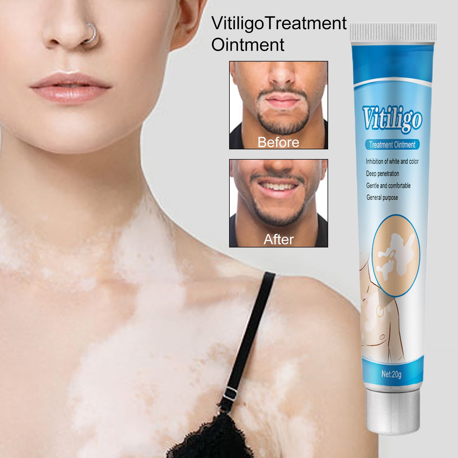 Piebaldism Vs Vitiligo