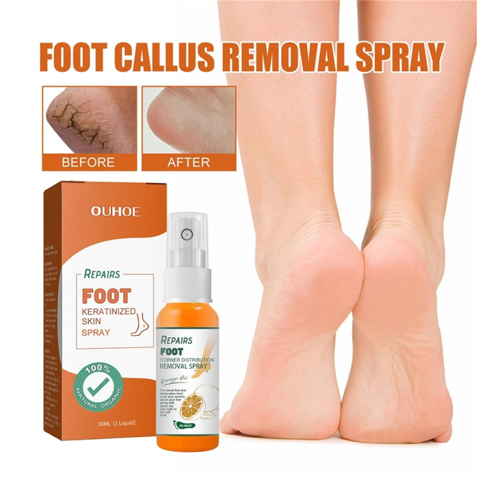 Gzwccvsn Foot Callus Removal Spray Foot Peeling Cream,for Remove Dead