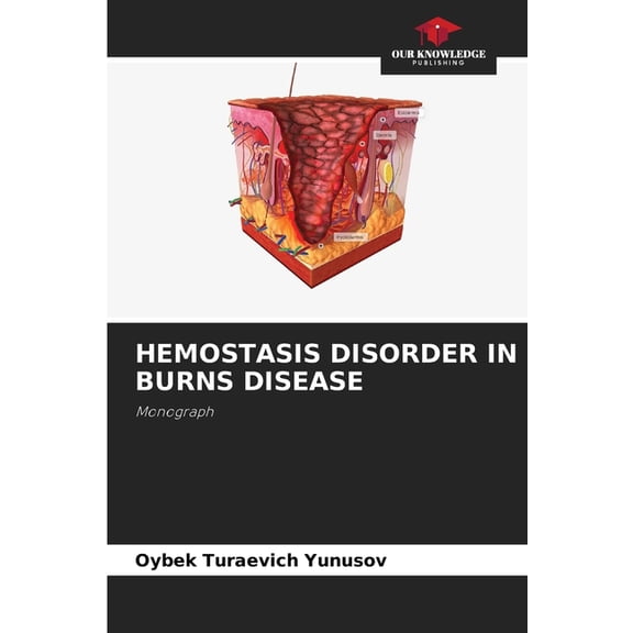Hemostasis Disorder in Burns Disease, (Paperback)