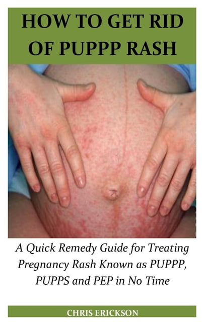 How to Get Rid of Puppp Rash : A Quick Remedy Guide for Treating Pregnancy  Rash Known as PUPPP, PUPPS and PEP in No Time (Paperback) 