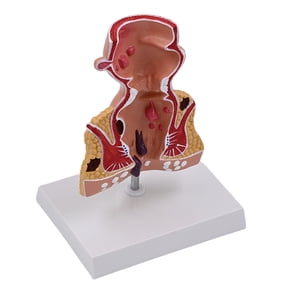 Human Anatomical Model Human Rectum Model Human Pathologies of Rectum Model Teaching Aid for Science Education
