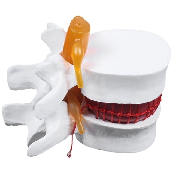 Human Anatomy Skeleton Spine Lumbar Disc Herniation Teaching Model