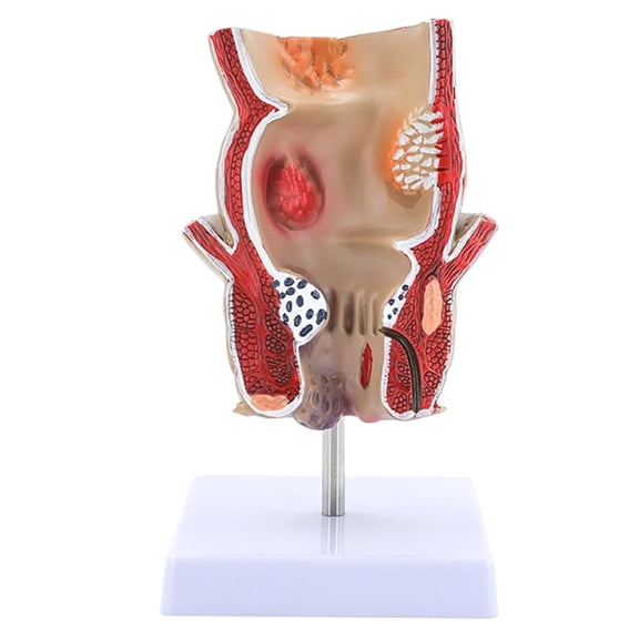 Human Rectum Model Human Anatomical Model Human Pathologies of Rectum Model