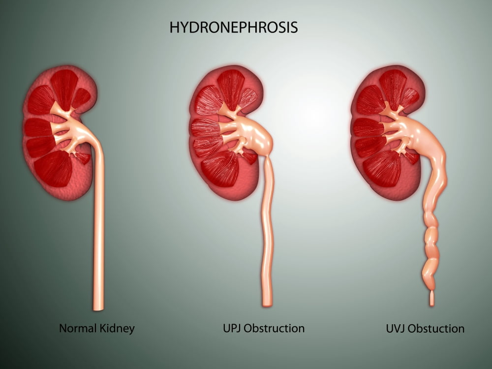 Hydronephrosis condition of the kidney Canvas Art - Stocktrek Images (33 x 25)