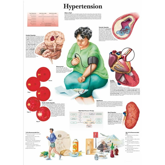 Hypertension Wall Art Posters Canvas Print Artwork Wall Chart Human Anatomy Wall Painting Office Hospital Room Home Decoration (without Framed),Multicolor,16x19.7 inch(40x50 cm)