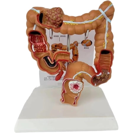 IULAVP Anatomy and Physiology Study Tools: 3D Colon Model Human Large Intestine Diseases Anatomical Model, 1:1 Life-Size Colon Pathology Model, Digestive System Teaching Model Anatomy Biology