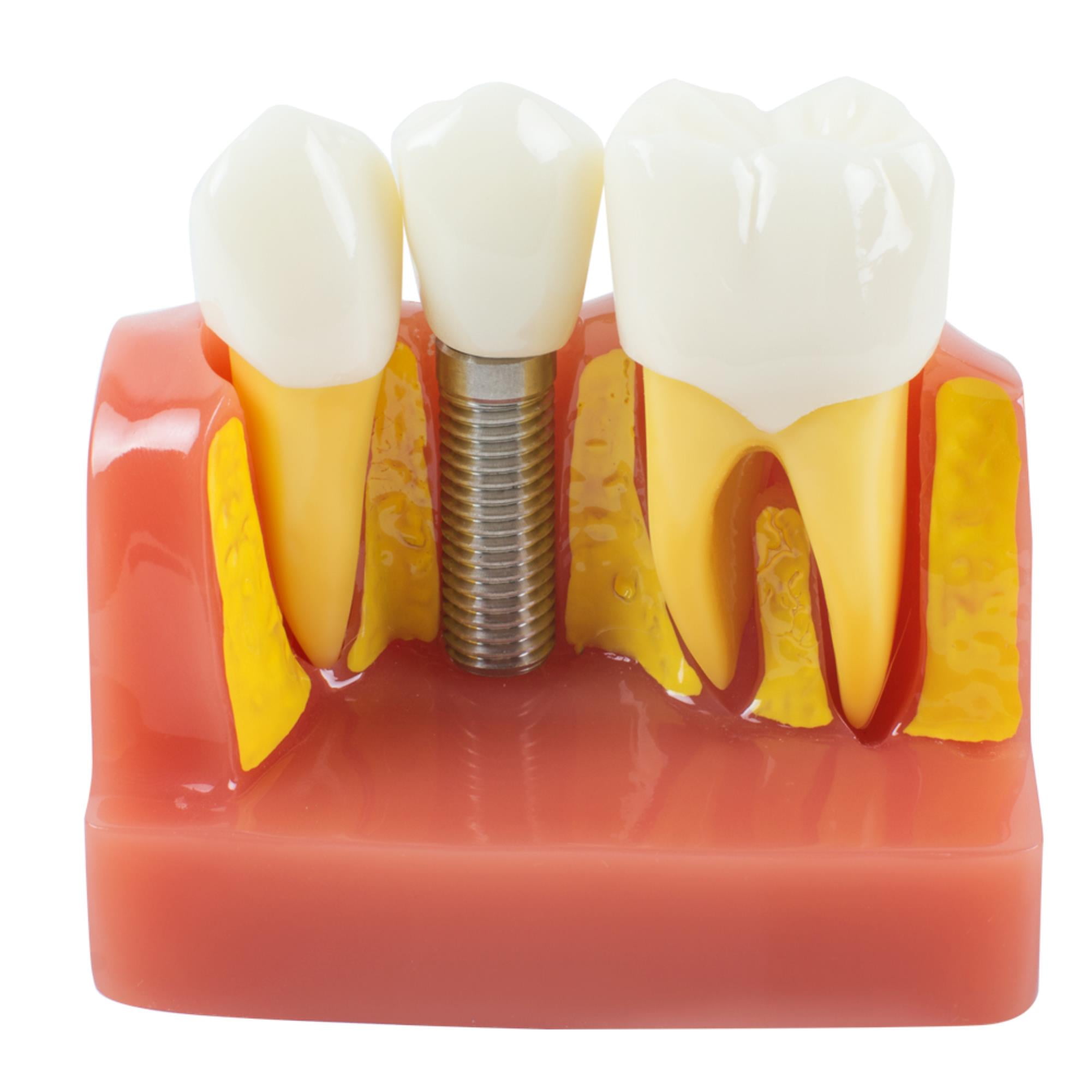 Ideal Dental Study Model for Dentists Advanced Removable Teeth Model