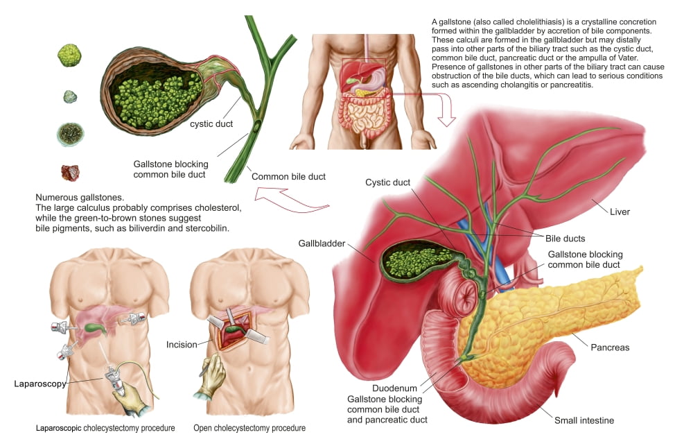 Illustration depicting cholecystectomy the surgical removal of the gallbladder Canvas Art - Stocktrek Images (18 x 12)