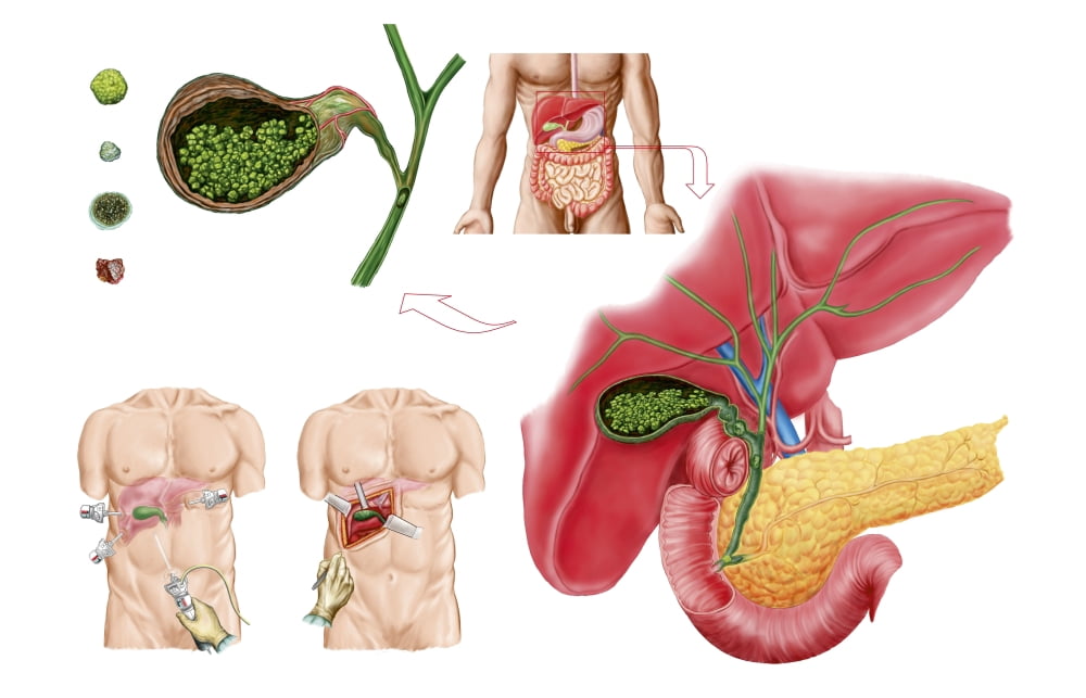 Illustration depicting cholecystectomy the surgical removal of the gallbladder Canvas Art - Stocktrek Images (18 x 12)