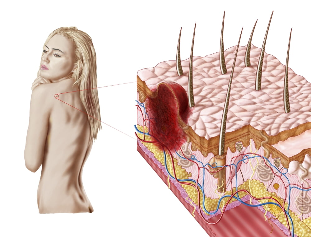 Illustration of an atypical growth on the skin that could be a sign of skin cancer Canvas Art - Stocktrek Images (33 x 25)