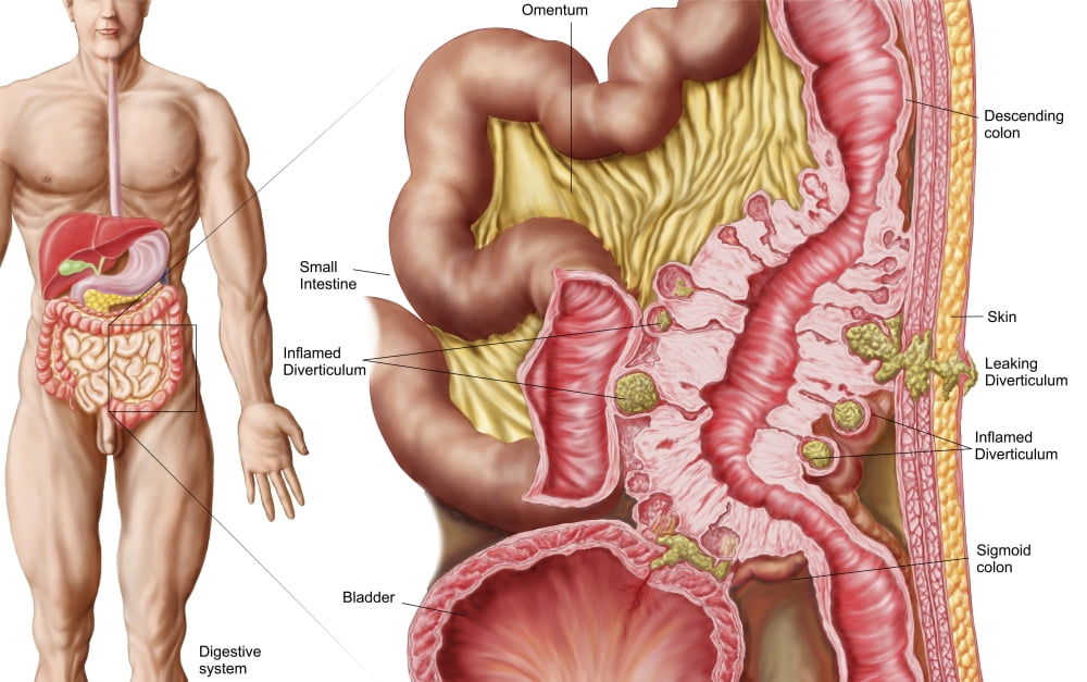 Illustration of diverticulosis in the colon Canvas Art - Stocktrek Images (35 x 22)
