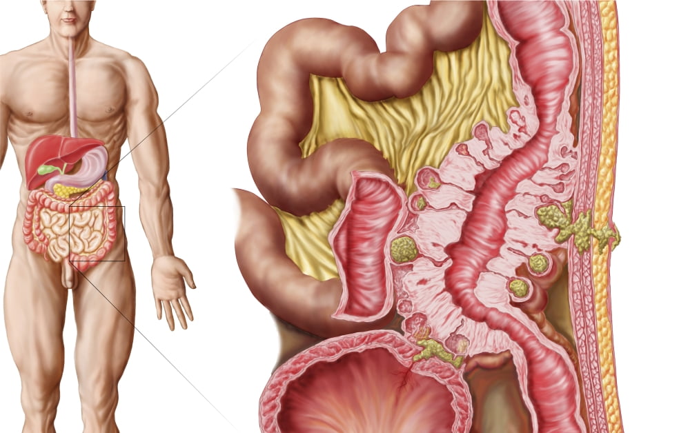 Illustration of diverticulosis in the colon Canvas Art - Stocktrek Images (35 x 22)