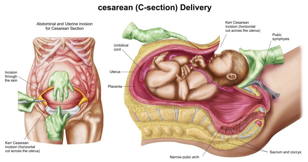 Illustration showing Caesarean delivery of fetus Canvas Art - Stocktrek Images (20 x 11)
